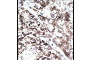 Formalin-fixed and paraffin-embedded human cancer tissue reacted with the primary antibody, which was peroxidase-conjugated to the secondary antibody, followed by DAB staining.