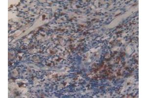 IHC-P analysis of Human Lung Cancer Tissue, with DAB staining. (MMP 9 anticorps  (AA 213-399))