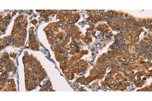 Immunohistochemistry of paraffin-embedded Human breast cancer using SPR Polyclonal Antibody at dilution of 1:40 (SPR anticorps)
