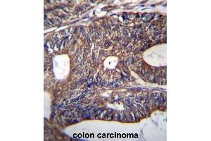 UQCRB Antibody (Center) immunohistochemistry analysis in formalin fixed and paraffin embedded human colon carcinoma followed by peroxidase conjugation of the secondary antibody and DAB staining.