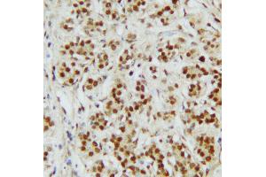 Anti-CTBP2 antibody, IHC(P) IHC(P): Human Mammary Cancer Tissue (CTBP2 anticorps  (C-Term))
