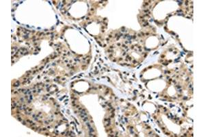 The image on the left is immunohistochemistry of paraffin-embedded Human thyroid cancer tissue using ABIN7128063(UCHL3 Antibody) at dilution 1/25, on the right is treated with fusion protein. (UCHL3 anticorps)