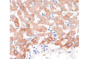Immunohistochemistry of paraffin-embedded Human liver cancer using CHAT Polyclonal Antibody at dilution of 1:200 (40x lens). (Choline Acetyltransferase anticorps)