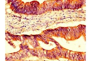 IHC image of ABIN7162123 diluted at 1:400 and staining in paraffin-embedded human colon cancer performed on a Leica BondTM system.