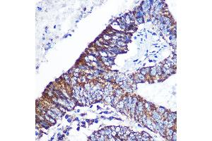Immunohistochemistry of paraffin-embedded Human colon carcinoma using DOK4 Rabbit pAb (ABIN3020721, ABIN3020722, ABIN3020723 and ABIN6213691) at dilution of 1:100 (40x lens). (DOK4 anticorps  (AA 240-326))
