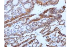 IHC testing of FFPE human thyroid carcinoma with TSH Receptor antibody (clone SPM222).