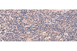 Immunohistochemistry of paraffin-embedded Human cervical cancer tissue using MAGEC2 Polyclonal Antibody at dilution of 1:60(x200)