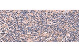 Immunohistochemistry of paraffin-embedded Human cervical cancer tissue using MAGEC2 Polyclonal Antibody at dilution of 1:60(x200) (MAGEC2 anticorps)
