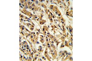 Formalin-fixed and paraffin-embedded human breast carcinoma reacted with SREBF1 Antibody (Center), which was peroxidase-conjugated to the secondary antibody, followed by DAB staining.