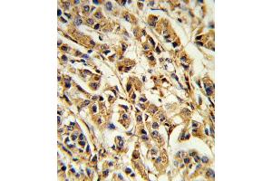 Formalin-fixed and paraffin-embedded human breast carcinoma reacted with SREBF1 Antibody (Center), which was peroxidase-conjugated to the secondary antibody, followed by DAB staining. (SREBF1 anticorps  (AA 349-378))