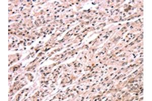The image on the left is immunohistochemistry of paraffin-embedded Human prostate cancer tissue using ABIN7190608(EXTL1 Antibody) at dilution 1/20, on the right is treated with synthetic peptide. (EXTL1 anticorps)