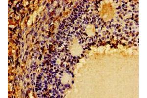 Immunohistochemistry of paraffin-embedded human ovarian cancer using ABIN7149290 at dilution of 1:100 (CD131 anticorps  (AA 492-710))