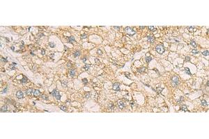 Immunohistochemistry of paraffin-embedded Human liver cancer tissue using STX5 Polyclonal Antibody at dilution of 1:70(x200)