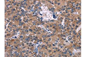 The image on the left is immunohistochemistry of paraffin-embedded Human liver cancer tissue using ABIN7192381(SKI Antibody) at dilution 1/40, on the right is treated with synthetic peptide. (SKI anticorps)