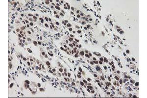 Immunohistochemical staining of paraffin-embedded Carcinoma of Human lung tissue using anti-GTF2F1 mouse monoclonal antibody. (GTF2F1 anticorps)