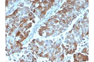 Formalin-fixed, paraffin-embedded human Renal Cell Carcinoma stained with OX40 Mouse Monoclonal Antibody (OX40/3108).