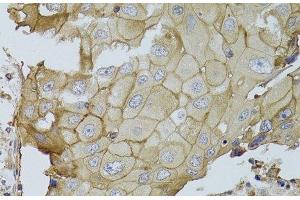 Immunohistochemistry of paraffin-embedded Human breast cancer using GGT1 Polyclonal Antibody at dilution of 1:100 (40x lens). (GGT1 anticorps)
