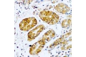 Immunohistochemical analysis of TMPRSS2 staining in human stomach cancer formalin fixed paraffin embedded tissue section. (TMPRSS2 anticorps)