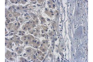 IHC-P Image Immunohistochemical analysis of paraffin-embedded human hepatoma, using PME-1, antibody at 1:500 dilution. (PPME1 anticorps)