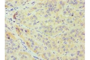 Immunohistochemistry of paraffin-embedded human liver cancer using ABIN7148700 at dilution of 1:100 (CRY1 anticorps  (AA 507-586))