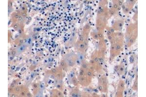 Detection of MET in Human Liver cancer Tissue using Polyclonal Antibody to C-Met (MET)