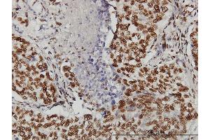 Immunoperoxidase of monoclonal antibody to TOPORS on formalin-fixed paraffin-embedded human lung, adenosquamous cell carcinoma.
