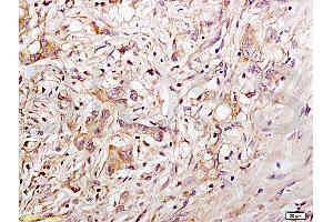 Formalin-fixed and paraffin embedded human gastric carcinoma tissue labeled with Anti-CD34 Polyclonal Antibody, Unconjugated (ABIN676898) at 1:200 followed by conjugation to the secondary antibody and DAB staining (CD34 anticorps  (AA 201-300))