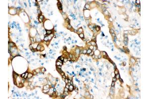 FASN was detected in paraffin-embedded sections of human intestinal cancer tissues using rabbit anti- FASN Antigen Affinity purified polyclonal antibody at 1 μg/mL. (Fatty Acid Synthase anticorps  (AA 1-226))