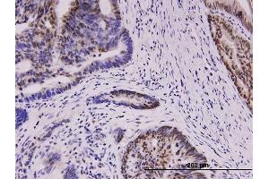Immunoperoxidase of monoclonal antibody to WT1 on formalin-fixed paraffin-embedded human colon cancer.