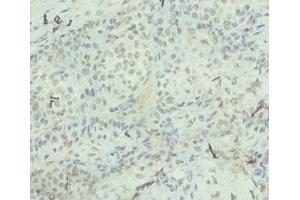 Immunohistochemistry of paraffin-embedded human breast cancer using ABIN7156933 at dilution of 1:100 (IL-8 anticorps  (AA 23-99))