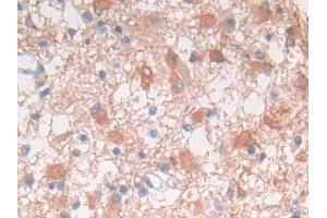 DAB staining on IHC-P; Samples: Human Glioma Tissue