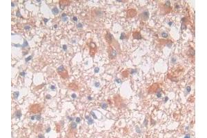 DAB staining on IHC-P; Samples: Human Glioma Tissue (FRK anticorps  (AA 234-491))