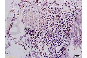 Formalin-fixed and paraffin embedded human colon carcinoma tissue with Anti-IFABP Polyclonal Antibody, Unconjugated (ABIN728173) at 1:200, followed by conjugation to the secondary antibody and DAB staining