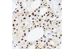Immunohistochemistry of paraffin-embedded human liver cancer using hnRNP Q/SYNCRIP /SYNCRIP Rabbit mAb (ABIN7270673) at dilution of 1:100 (40x lens). (SYNCRIP anticorps)