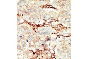 Formalin-fixed and paraffin-embedded human cancer tissue reacted with the primary antibody, which was peroxidase-conjugated to the secondary antibody, followed by DAB staining. (FGFR3 anticorps  (C-Term))