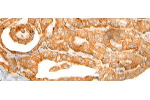 Immunohistochemistry of paraffin-embedded Human thyroid cancer tissue using CEP72 Polyclonal Antibody at dilution of 1:40(x200)
