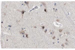 ABIN6272383 at 1/100 staining Human brain cancer tissue by IHC-P. (PDE4B/C/D anticorps)