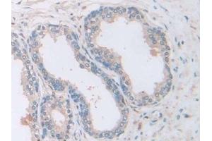 Detection of CAP2 in Human Prostate Tissue using Polyclonal Antibody to Adenylyl Cyclase Associated Protein 2 (CAP2)