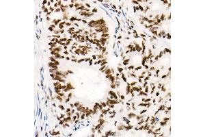 Immunohistochemistry of paraffin-embedded Human colon carcinoma using SM/SNF5 antibody (ABIN7270657) at dilution of 1:1000 (40x lens).