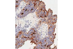 Immunohistochemical analysis of paraffin-embedded Human colon carcinoma tissue using (ABIN391544 and ABIN2841493) performed on the Leica® BOND RXm. (CEACAM5 anticorps  (N-Term))