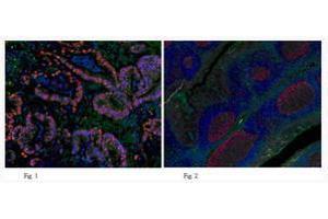 Immunofluorescent analysis of human colon adenocarcinomat tissue (Fig. (PCNA anticorps)