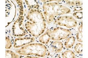 ABIN6260268 and ABIN6276437 at 1/100 staining Human kidney cancer and adjacent normal tissues by IHC-P. (BIRC2 anticorps  (C-Term))