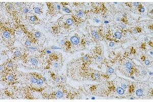 Immunohistochemistry of paraffin-embedded Human liver damage using NPC2 Polyclonal Antibody at dilution of 1:100 (40x lens). (NPC2 anticorps)