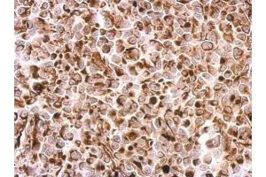 IHC-P Image Desmin antibody detects DES protein at cytosol on H1299 xenograft by immunohistochemical analysis.