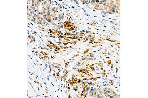 Immunohistochemistry of paraffin embedded human colon cancer using CSF1 (ABIN7073553) at dilution of 1:900 (400x lens)