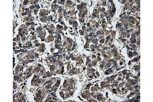 Immunohistochemical staining of paraffin-embedded Carcinoma of liver tissue using anti-GBE1mouse monoclonal antibody. (GBE1 anticorps)