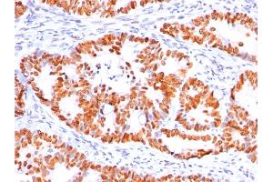 Formalin-fixed, paraffin-embedded human Colon Carcinoma stained with p53 Mouse Monoclonal Antibody (BP53-12).