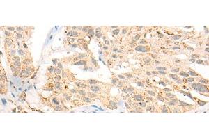 Immunohistochemistry of paraffin-embedded Human esophagus cancer tissue using CCT8L2 Polyclonal Antibody at dilution of 1:45(x200) (CCT8L2 anticorps)