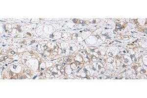 Immunohistochemistry of paraffin-embedded Human liver cancer tissue using PHPT1 Polyclonal Antibody at dilution of 1:210(x200)