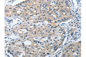 The image on the left is immunohistochemistry of paraffin-embedded Human lung cancer tissue using ABIN7128398(ANAPC13 Antibody) at dilution 1/25, on the right is treated with fusion protein. (ANAPC13 anticorps)